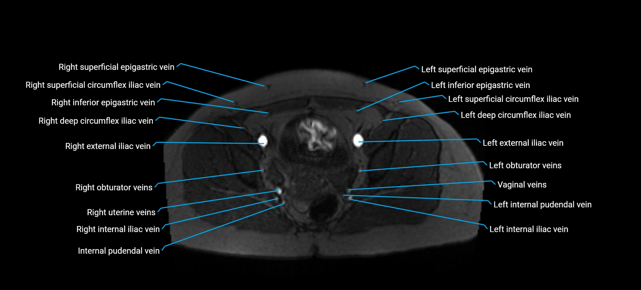 MRV abdomen pelvis & lower limb axial cross sectional anatomy labelled MRI image 165 (1).webp